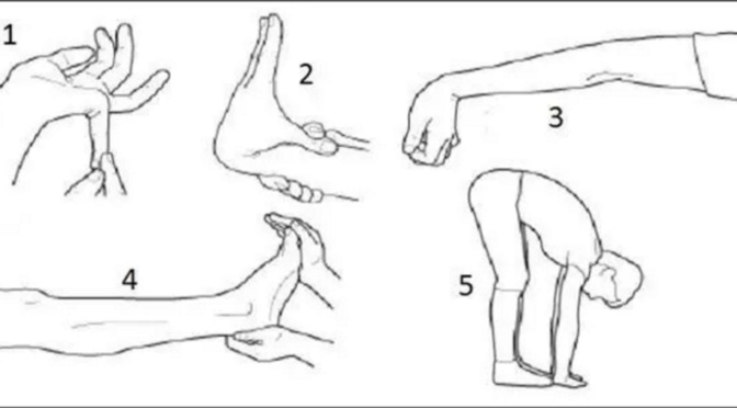 This is an image from a medical textbook demonstrating different kinds of hypermobility that may occur in people with Ehlers-Danlos syndrome.