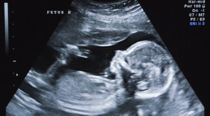 This is an image of an ultrasound of a fetus with signs of Down syndrome.